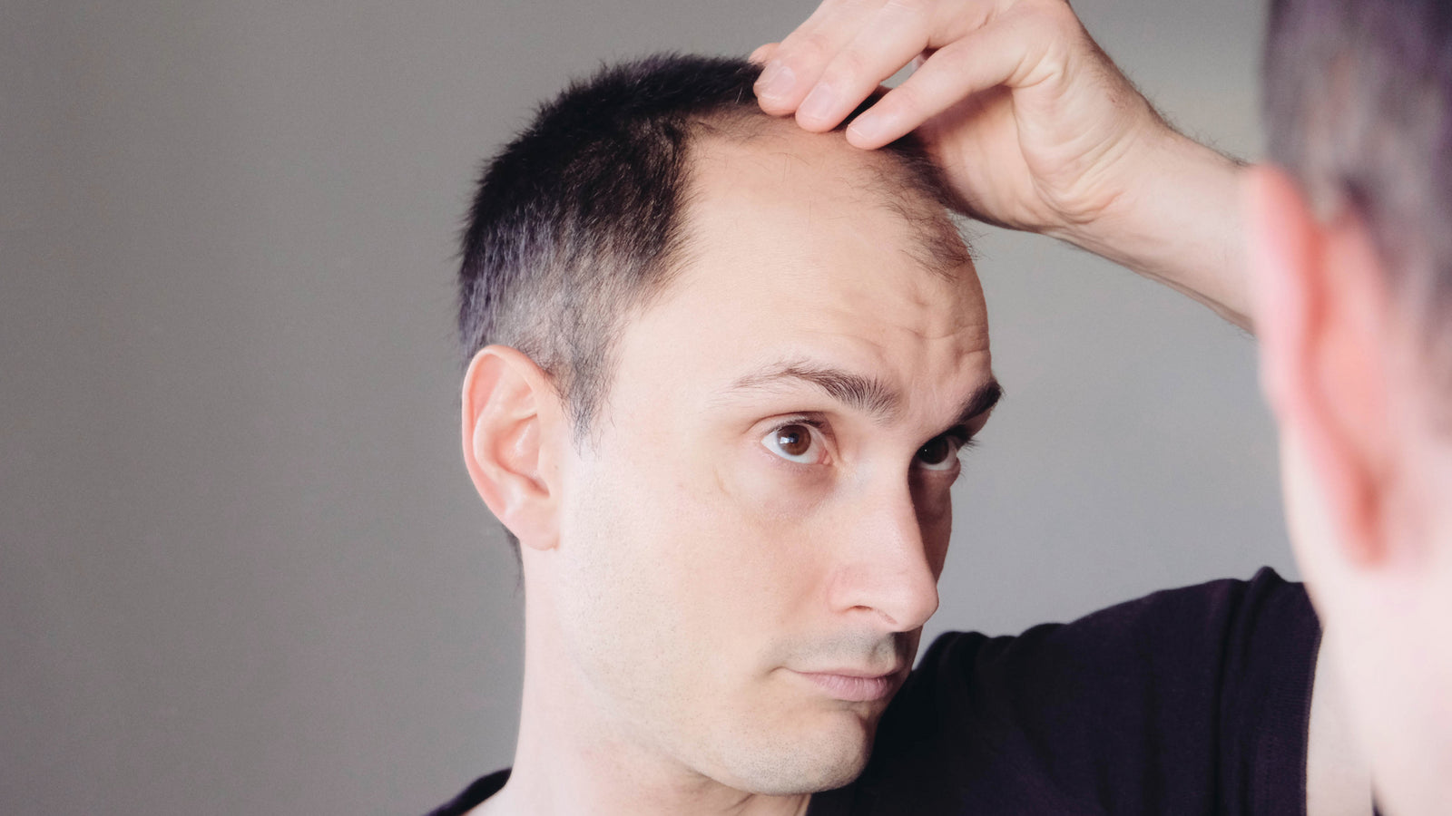Hair Loss – Male Pattern Baldness